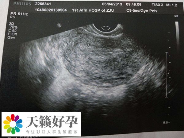 人授失敗轉試管要注意調整子宮環境