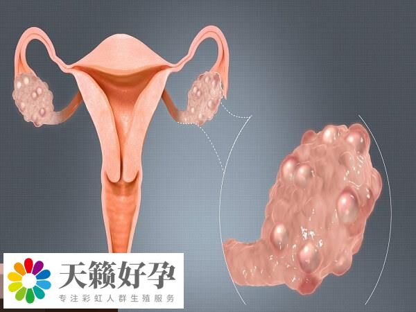 輸卵管存在炎症大部分會(hui) 有積水