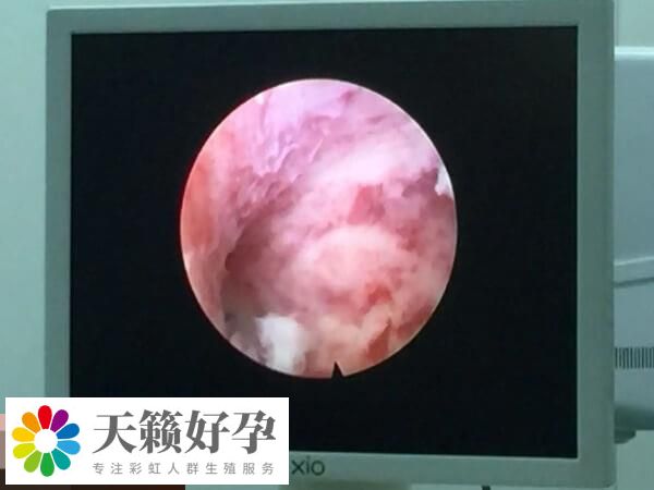 宮腔鏡可以確診宮腔疾病