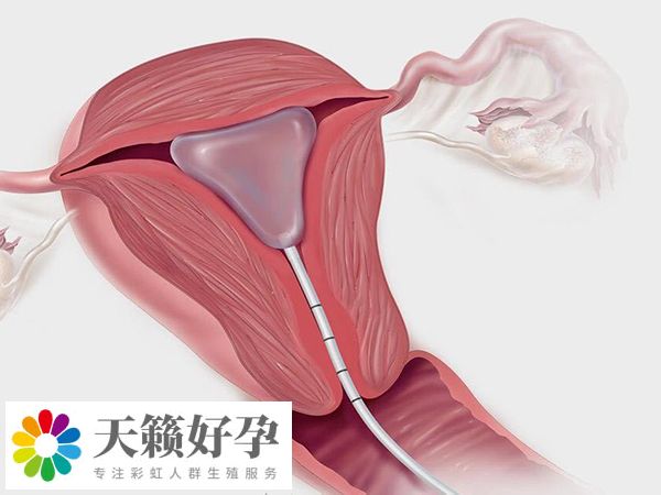 宮內(nei) 探查能發現宮腔粘連