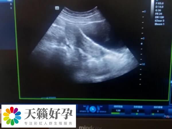 內(nei) 膜形態異常一般不建議移植鮮胚