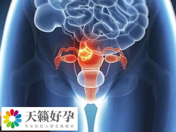 不當使用賀美奇會(hui) 導致卵巢過度刺激